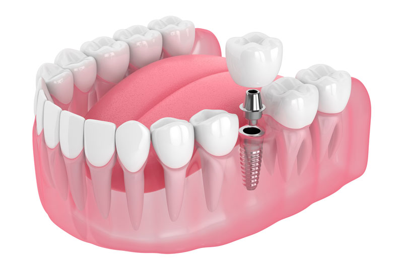 A 3D rendering of a dental implant in a pink gum model, showing a metal screw with an abutment and crown, illustrating the replacement of a single missing tooth.
